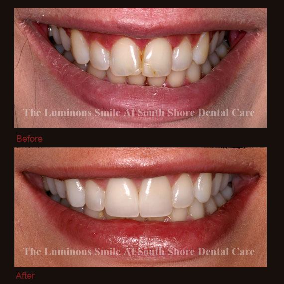 Red and uneven gum line and recontouring