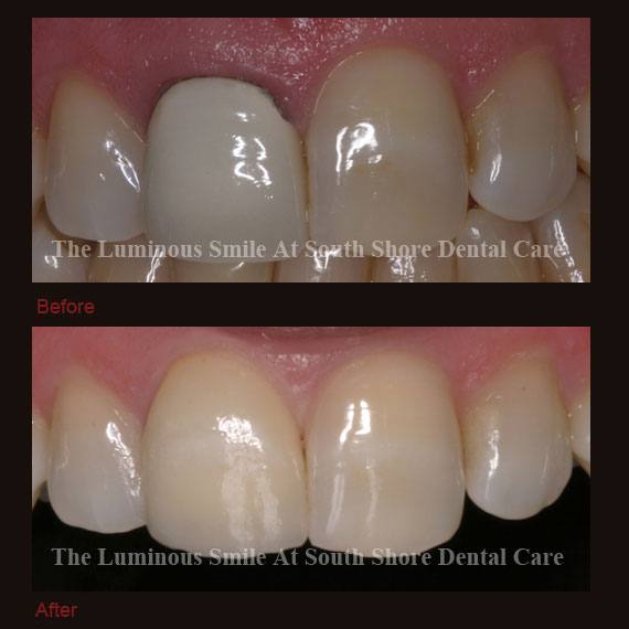 Uneven gums and recontouring