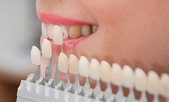Smile compared with tooth color chart