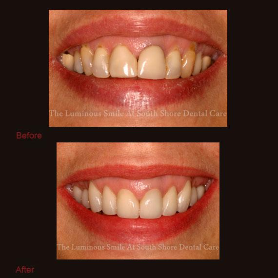 Darkly colored tooth with crown repair