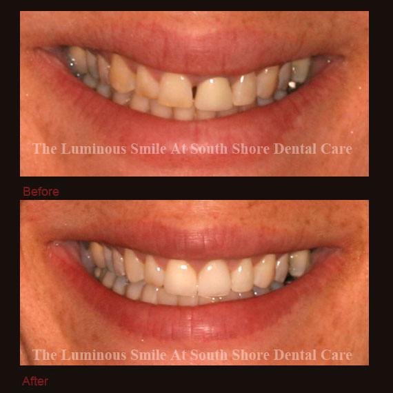 Dental crown restoration