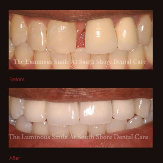 Gap between front teeth repaired with crowns
