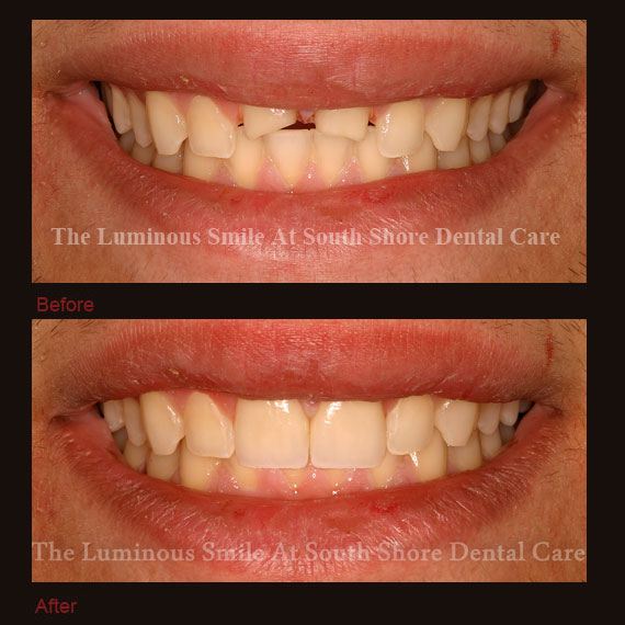 Short front teeth repaired with crowns