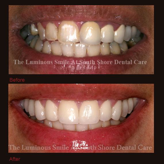 Darkly colored front teeth repaired with crowns