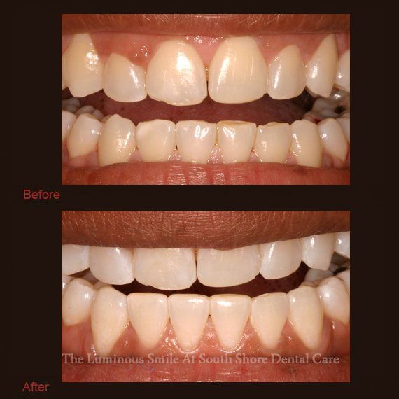 Incorrectly formed teeth and enamel shaping