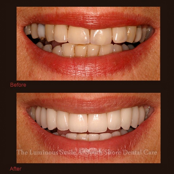 Misshapen teeth and enamel shaping