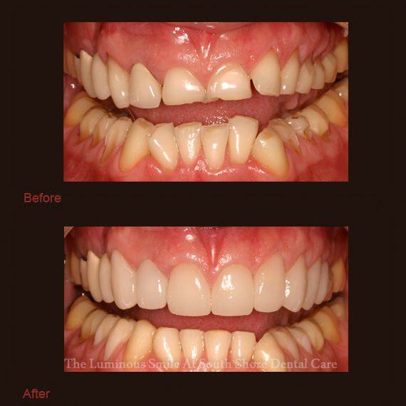 Stubby misshapen teeth and enamel shaping