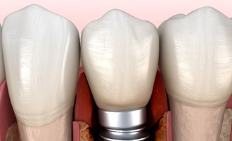 Bone loss around implant leading to dental implant failure in Massapequa Park, NY