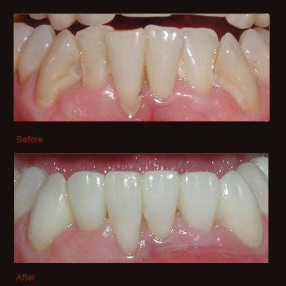 Crowded bottom teeth and porcelain veneers