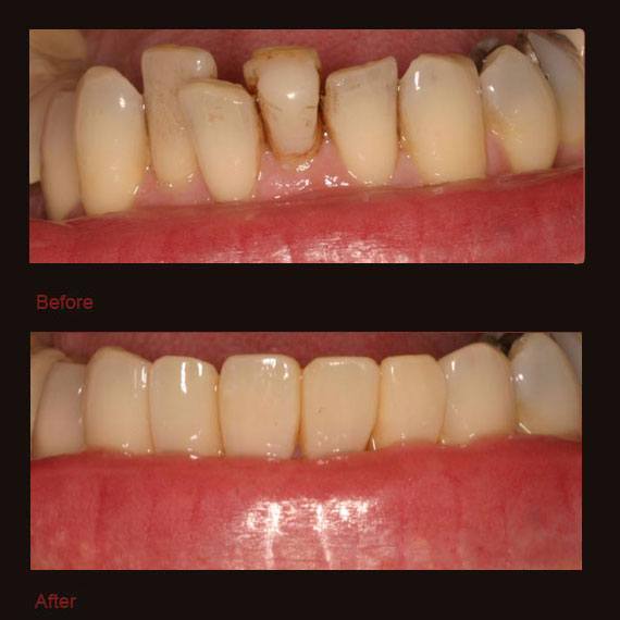 Crooked bottom teeth and porcelain veneers