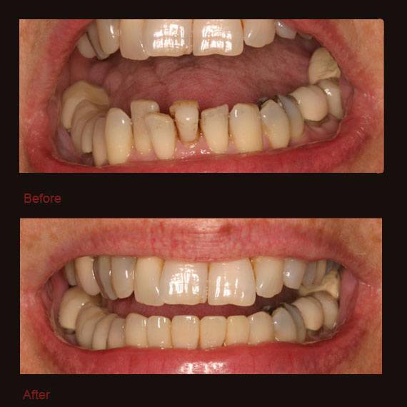 Overlapping bottom teeth and porcelain veneers