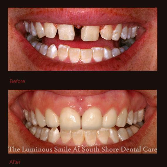Large gap between front teeth and porcelain veneers