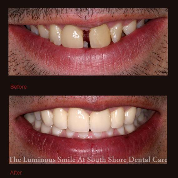 Gapped front teeth and porcelain veneers