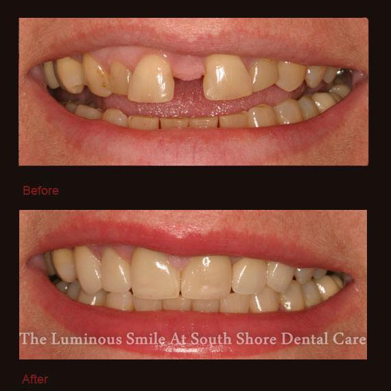 Severe gap between front teeth and porcelain veneers