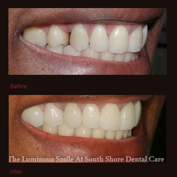 Gap between side teeth and porcelain veneers