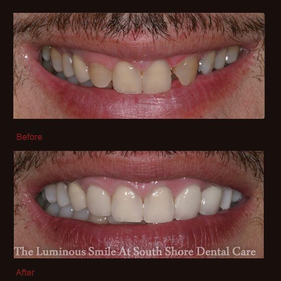 Gap between front teeth and incisors and porcelain veneers