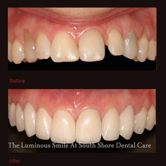 Gap between side teeth and porcelain veneers