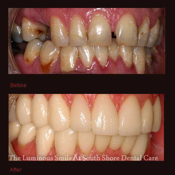 Several gaps between damaged teeth and porcelain veneers