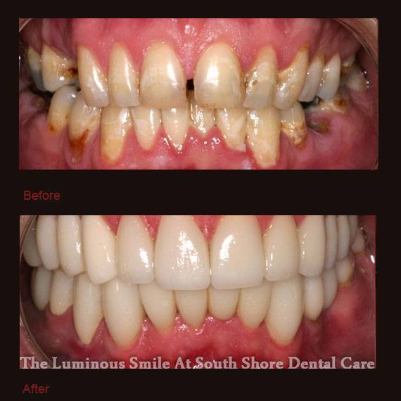 Numerous dental gaps and flaws and porcelain veneers