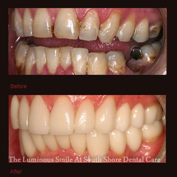 Gapped and crooked teeth and porcelain veneers