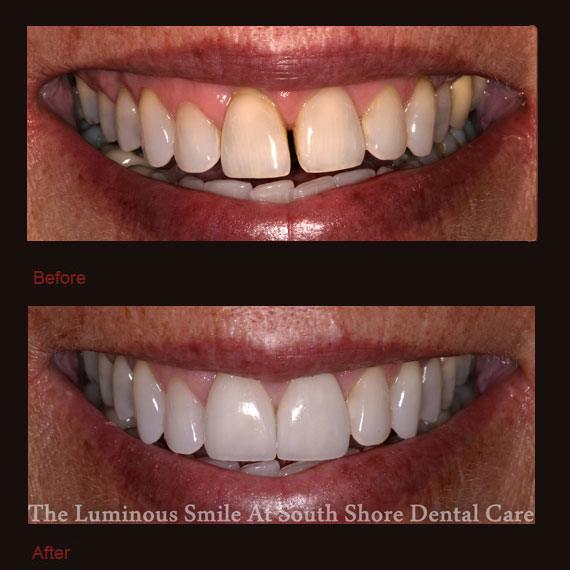 Yellow and gapped front teeth and porcelain veneers