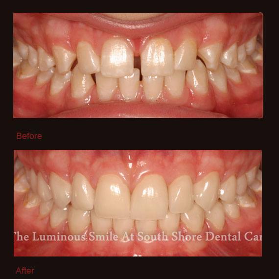 Unevenly spaced teeth and porcelain veneers