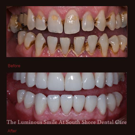 Unevenly spaced bottom teeth and porcelain veneers