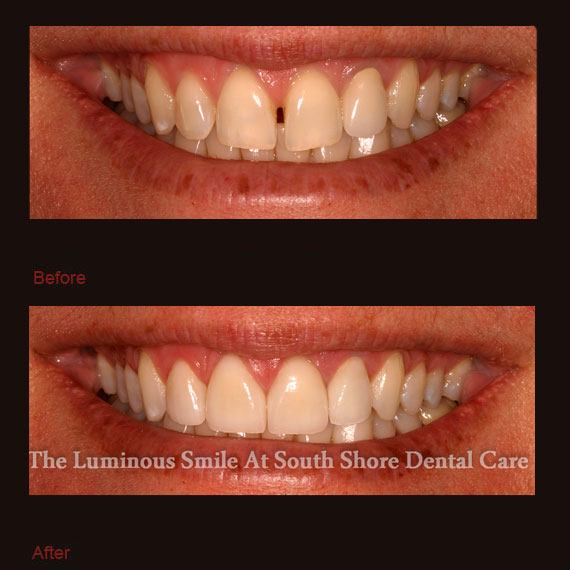 Gapping front teeth and porcelain veneers repair