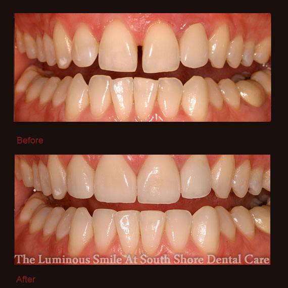 Front two teeth gapped and porcelain veneers repaired