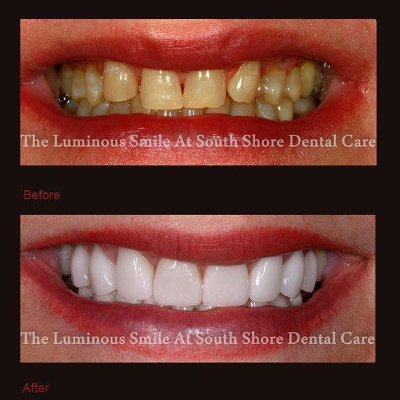 Yellow and unevenly spaced teeth and porcelain veneers repair