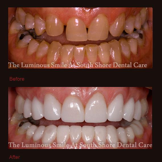 Severely damaged uneven teeth and porcelain veneers