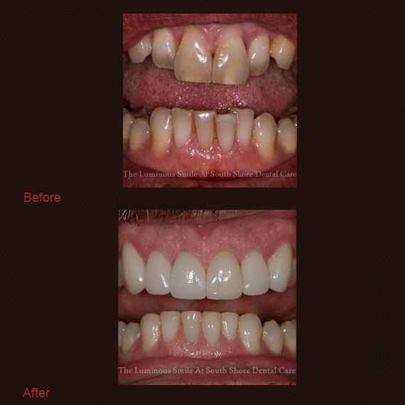 Before and after images dark colored teeth and full veneer
