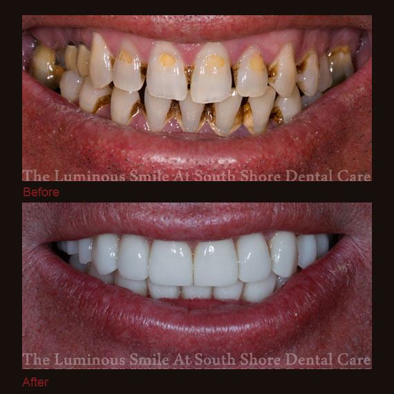 Before and after images severe tooth damage and full veneers