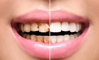 Teeth before and after full mouth reconstruction