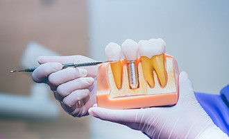 diagram showing the preliminary work and implant procedure