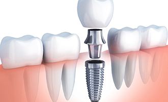 parts of dental implants in Massapequa