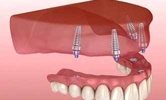 A digital image of an implant denture attaching to dental implants in the upper arch in Massapequa