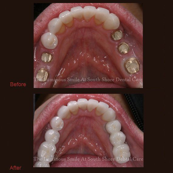 Five back teeth implants and replacement bridges