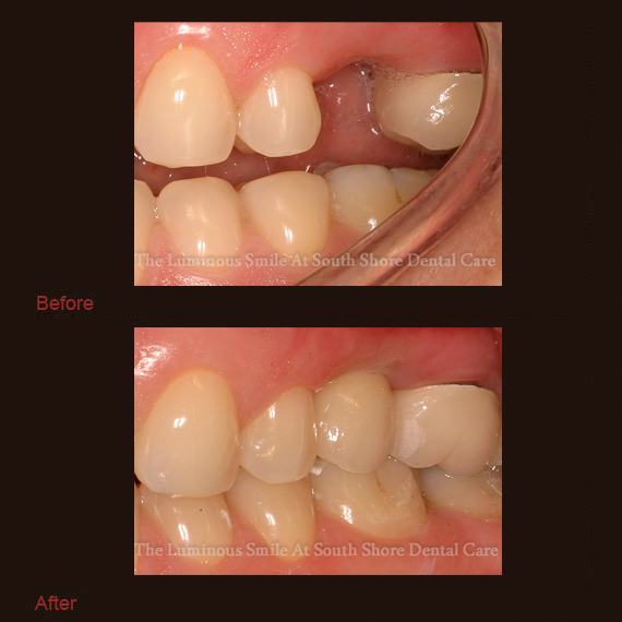 One missing top tooth and implant retained crown