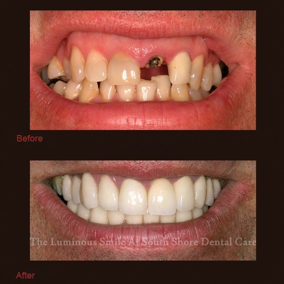 Front tooth implant and dental crown restoration