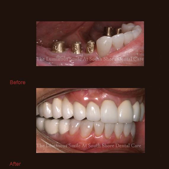 Dental implants in gum line and fixed bridges