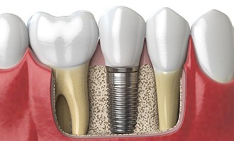 Diagram of dental implants in Massapequa Park