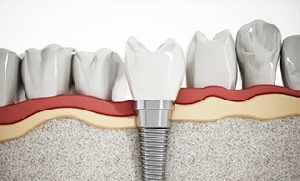 Diagram of how dental implants work in Massapequa Park