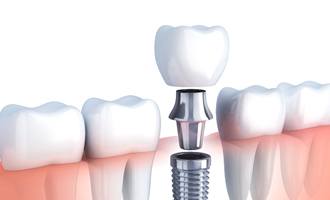 dental implant