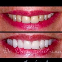Close up of a smile before and after cosmetic dentistry in Massapequa Park