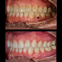 Closeup of smile before and after dental treatment in Massapequa Park