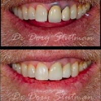 Closeup of smile before and after treatment