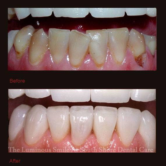 Yellowed decayed bottom teeth and veneers