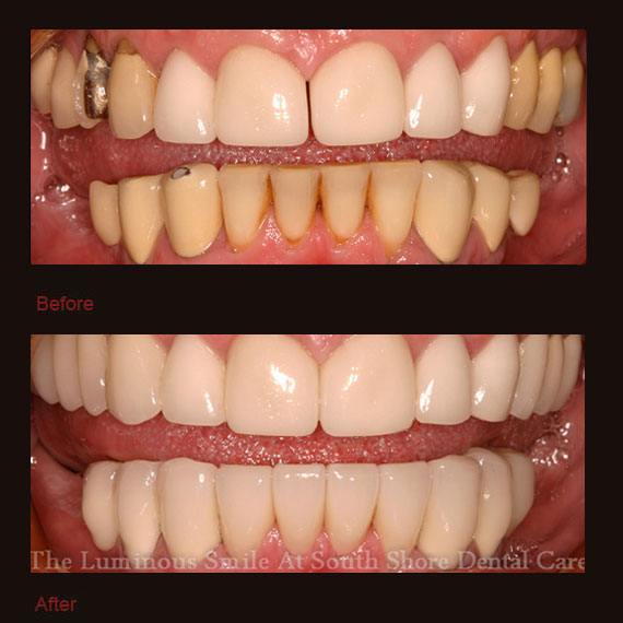 Damaged and yellow bottom teeth and veneers