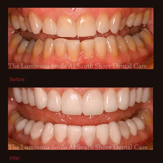 Dark colored bottom teeth and veneers